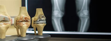 Total knee replacement explained : Nursing made Incredibly .